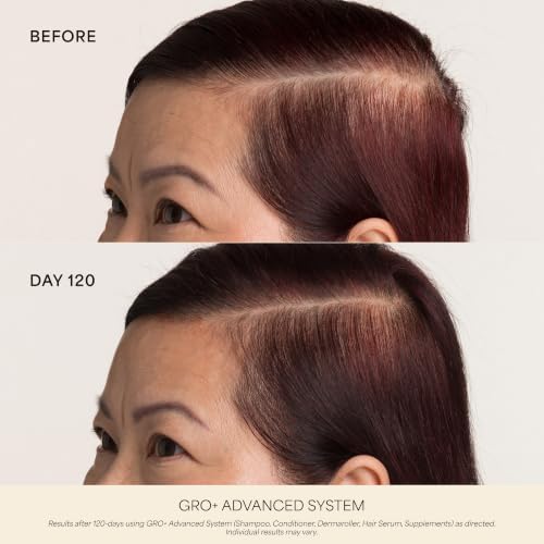 VEGAMOUR Scalp Dermaroller - MD-Developed, 1,200 Medical-Grade Needles, Enhances Serum Absorption, Twist-On Replaceable Head, Protective Case Included - Image 3