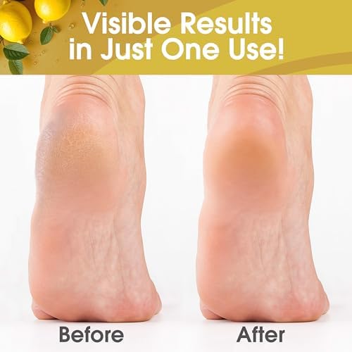 DeEnti Callus Remover for Feet, Foot Callus Remover Gel, 16oz Lemon Scent - Image 2