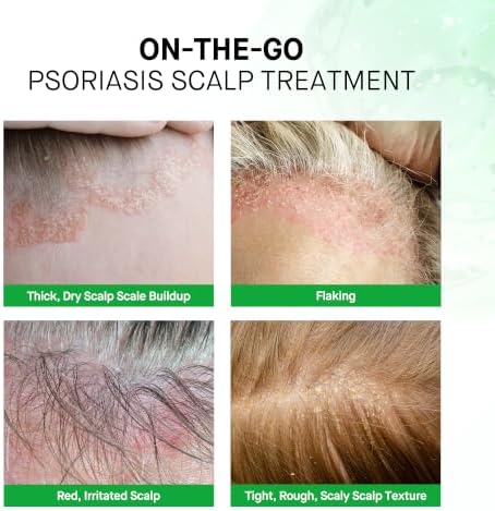 RoyceDerm Scalp Psoriasis Treatment Spray for Itch, Flaking and Scaling - Image 5