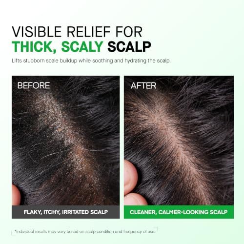 RoyceDerm Scalp Psoriasis Treatment Spray for Itch, Flaking and Scaling - Image 3